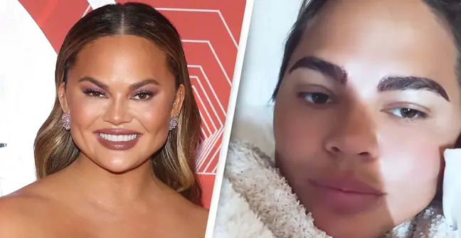 Chrissy Teigen before and after her eyebrow transplant