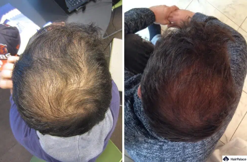 crown-hair-transplant-before-after hair transplant crown before and after