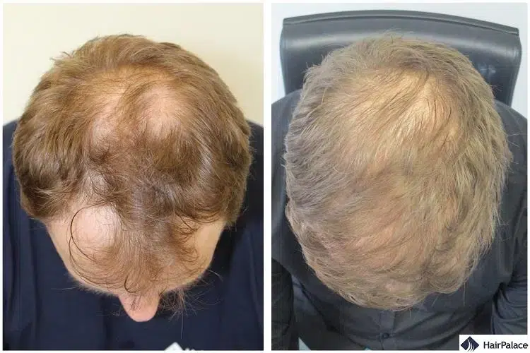 hair-transplant-before-and-after crown hair transplant results