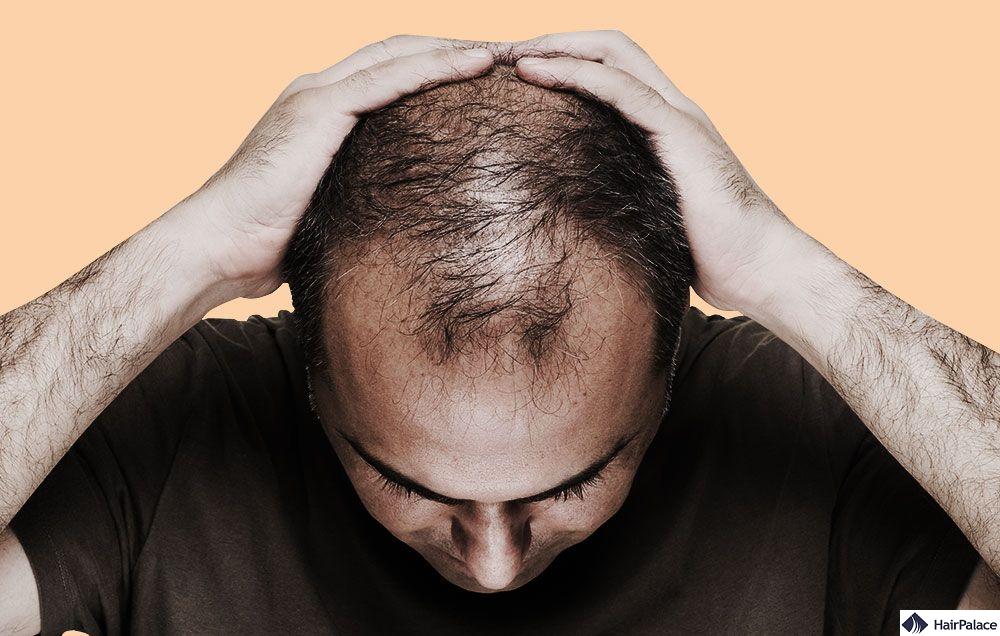 thinning hair for men