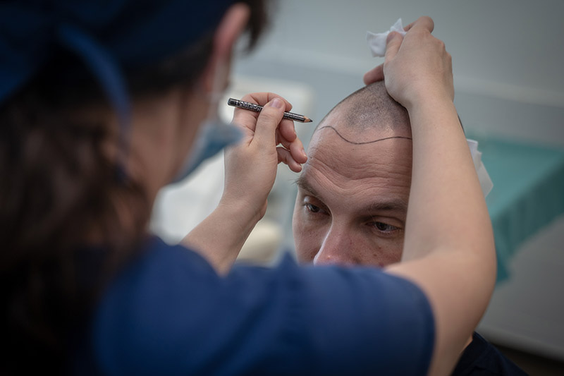 hair transplant hairline
